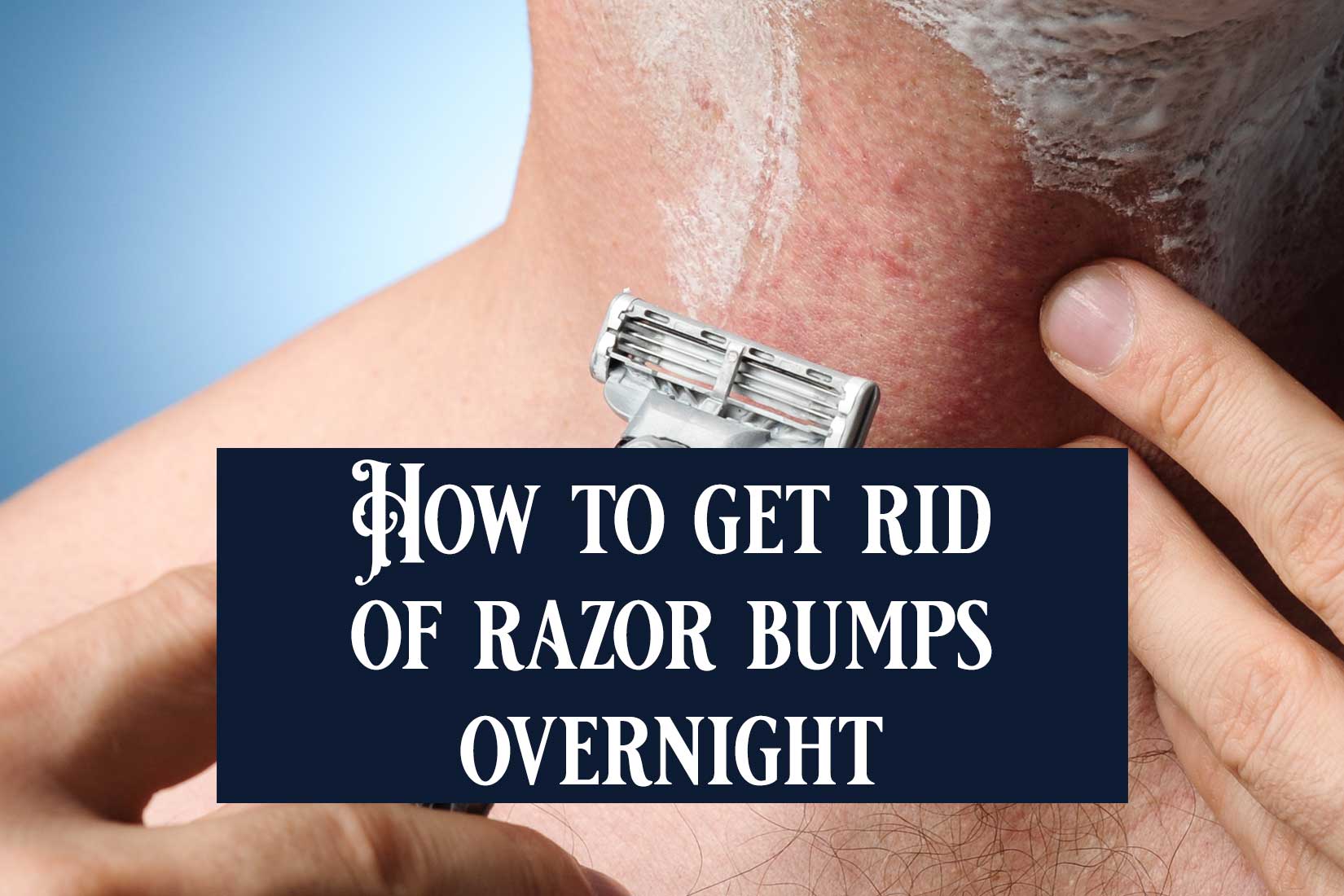 How to get rid of Razor Bumps Overnight